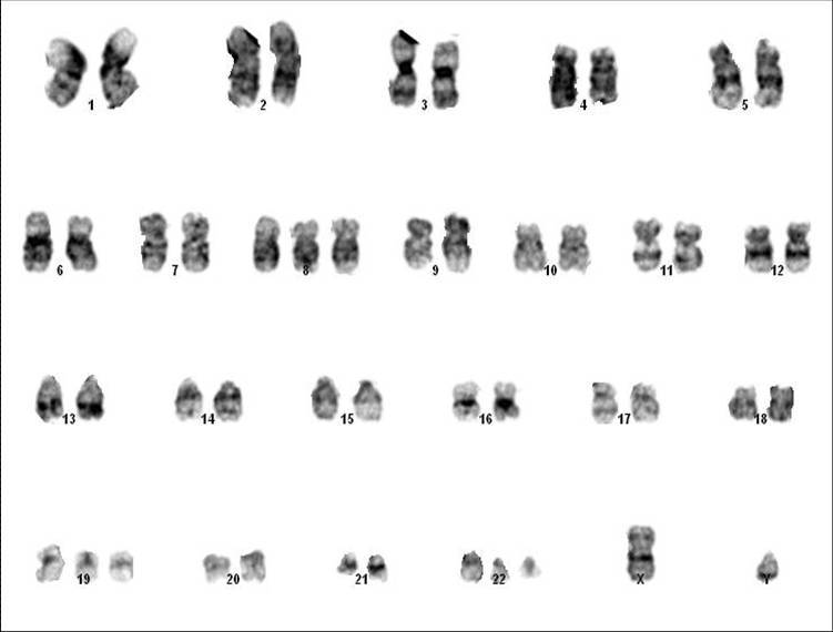 Cytogenetic analysis of lymph node showing complex karyotype with translocation (9;22)(Philadelphia), an additional Philadelphia chromosome, trisomy 8, trisomy 19 and deletion of the long arm of chromosome 4 (4q-)